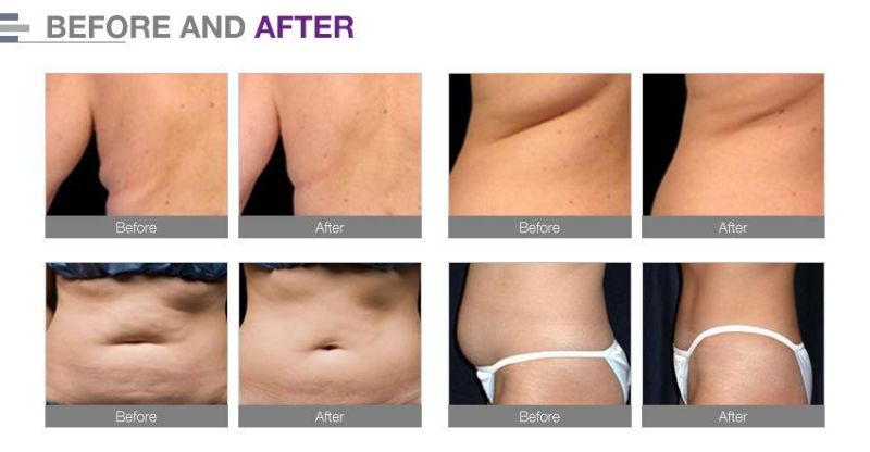 Fast Effective Weight Loss RF Cavitation Fast Body Slimming