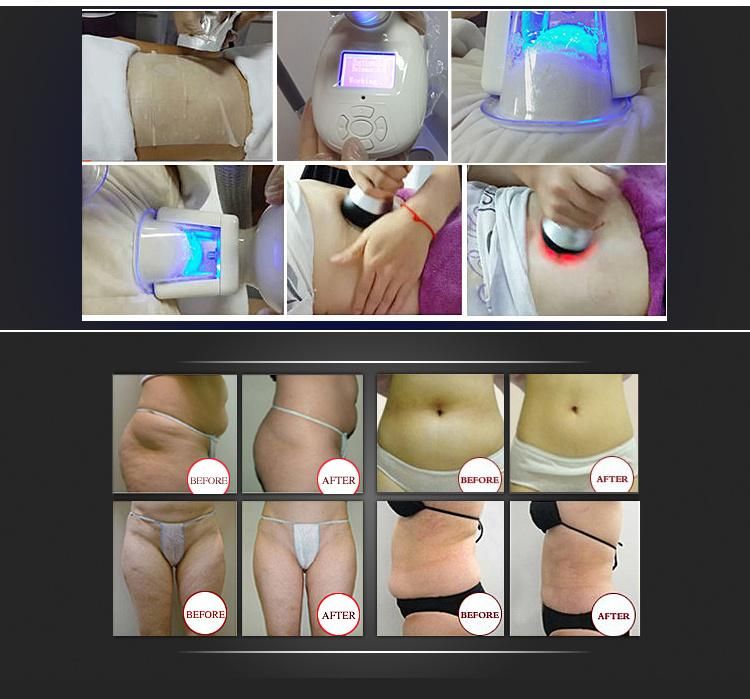 Cryolipolysis Freeze Fat Slimming Weight Loss Sculpting Machine