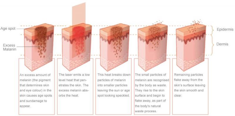 Medical Grande CE Approved Photodynamic Therapy PDT LED Light Machine for Acne Skin Rejuvenation