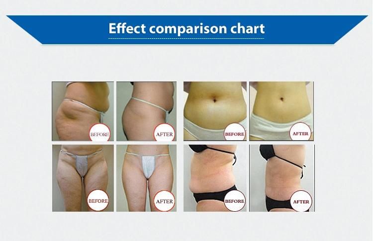 Popular Portable Slimming Machine Fat Freeze Technique Cryolipolysis System