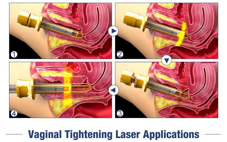 FDA Approved C02 Fractional Laser Beauty Machine for Skin Vaginal Resurfacing