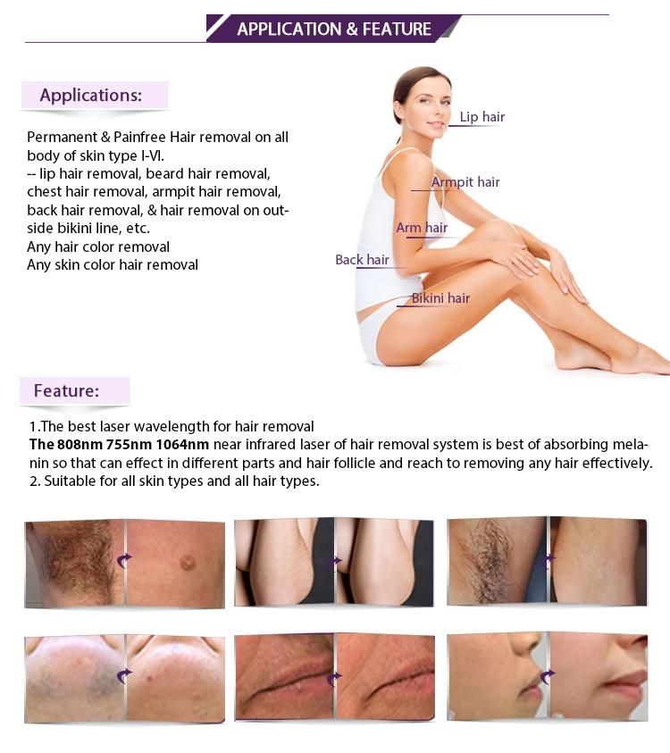 808nm Diode Laser Epilation for Permanent Hair Removal