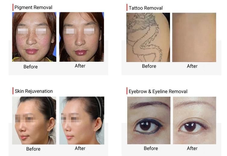 Skin Rejuvenation Picosecond Laser for Tattoo & Pigmentation Removal Machine