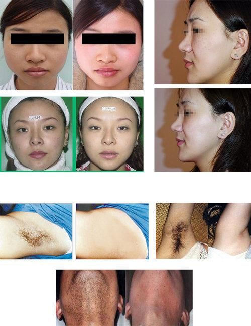 E-Light&RF System Skin Lifting Permanent Hair Removal