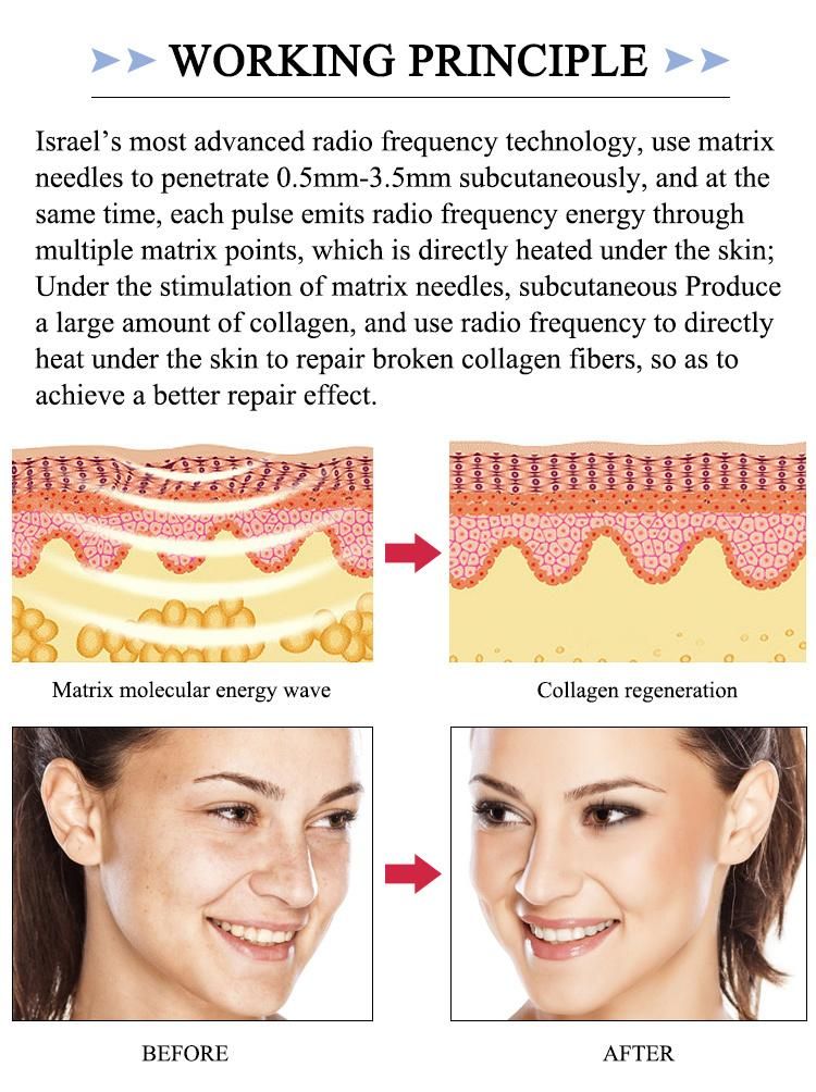 RF for Body and Face Skin Tightening with Fractional RF Microneedle Machine