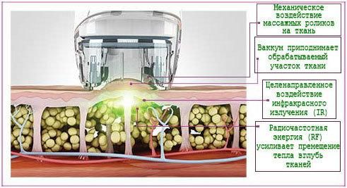 Vacuum RF Skin Lifting Body Shaping Cavitation Slimming Machine