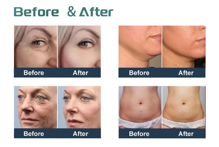 2022 High Energy 7D Hifu for Wrinkle Removal and Body Slimming Face Lifting Beauty Machine Ultra Micro and Macro Focused Ultrasound Anti-Aging Machine
