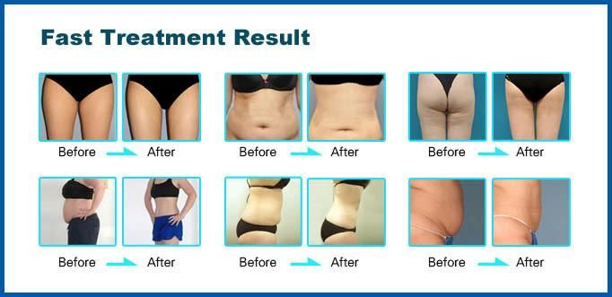 Distributors Wanted Laser Liposuction Equipment with 650 Diode and Cavitation