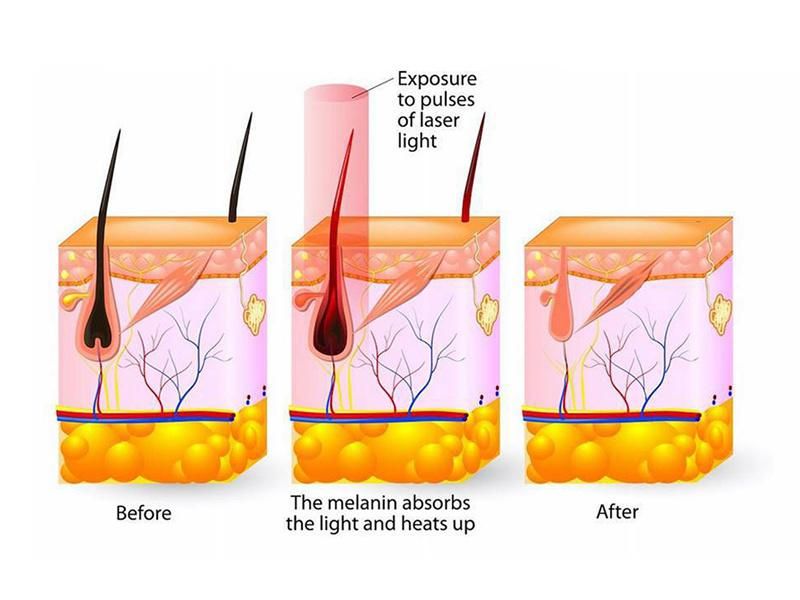 IPL Shr Laser Hair Removal Skin Rejuvenation Beauty Machine