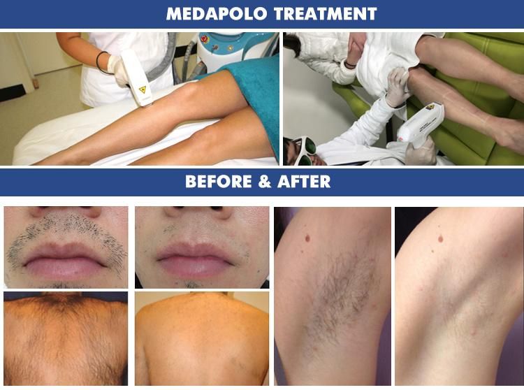 Med apolo professional diode laser with 755nm 808nm and 1064nm hair removal