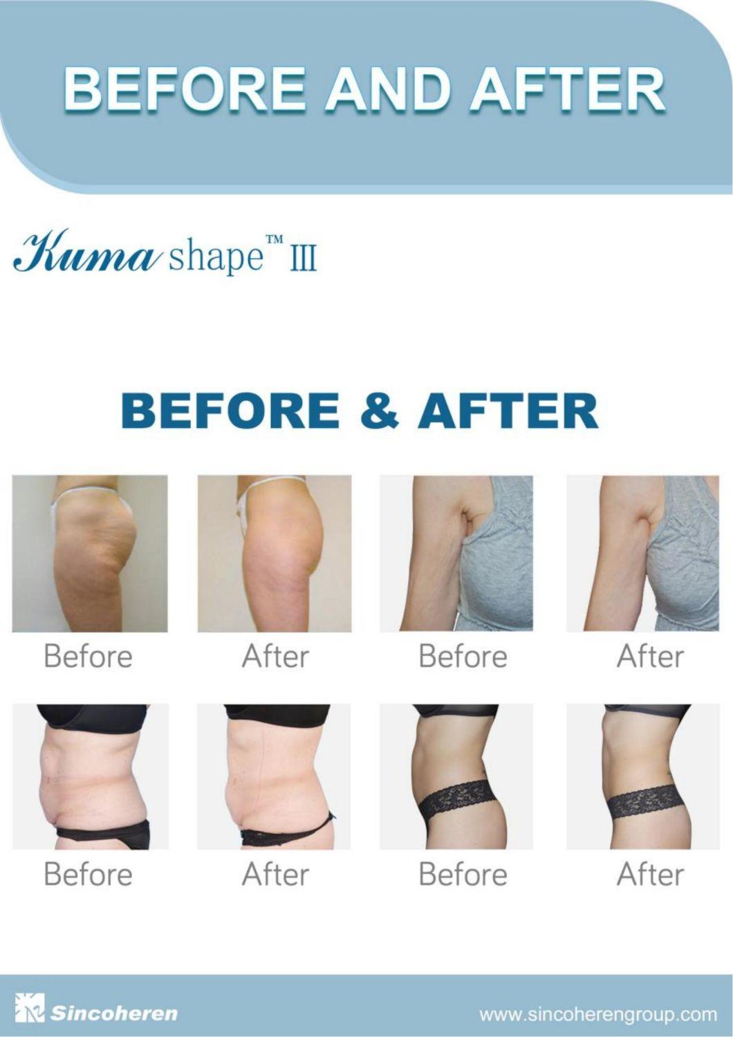 Sincoheren Kuma Shape Vertical Weight Loss with High Quality