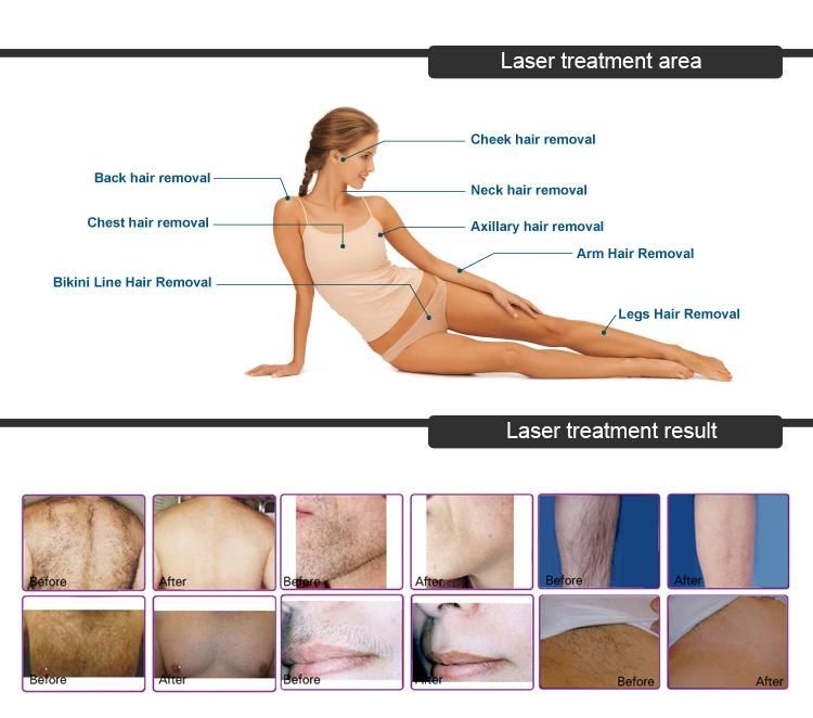 Aesthetic Diode Laser in Motion Permanent Hair Removal Machine