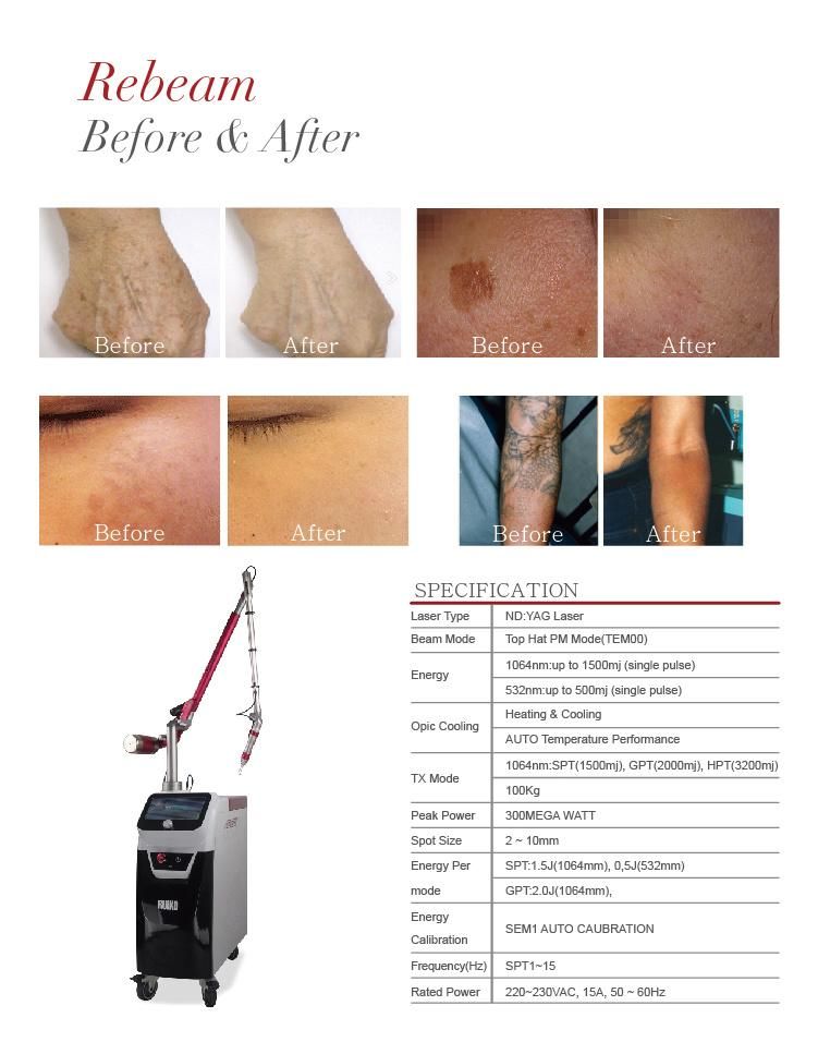 Single Pulse 1.5j ND YAG Laser Tattoo Removal Beauty Equipment
