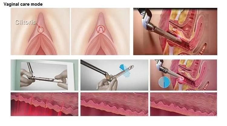 Professional Medical Surgical CO2 Fractional Laser Skin Resurface /Scar Remove/Vagina Tighten Beauty Equipment