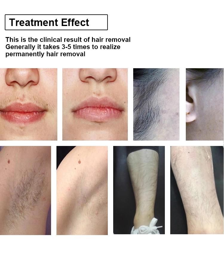 Permanent Hair Removal 2019 / 808 Diode Laser Hair Removal Machine Price