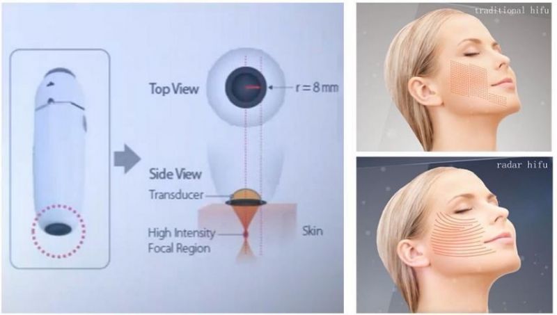 9d High Intensity Focused Ulrasound, Radar Higu, Liposonic, Hifu Machine