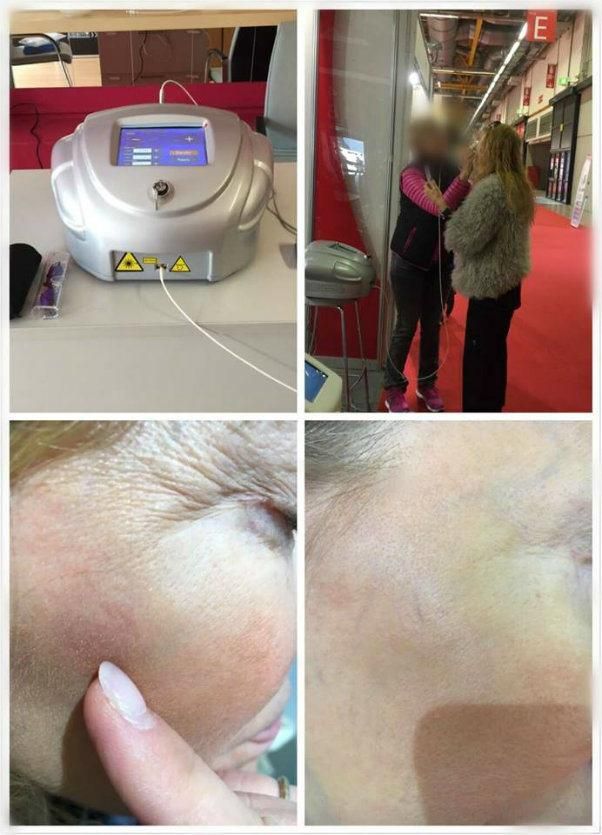 980nm Diode Laser Vascular Remove/ Vein Remove/ Spider Vein Remove Machine