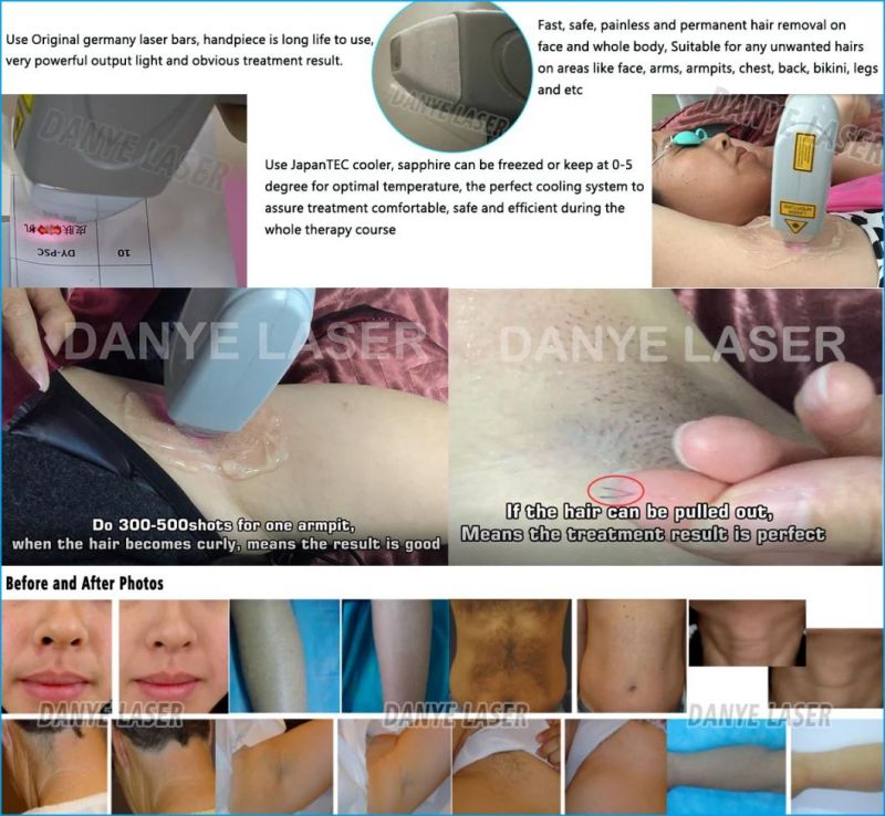 2018 Most Competitive Price Guangzhou Danye Laser Remove Hair Machine