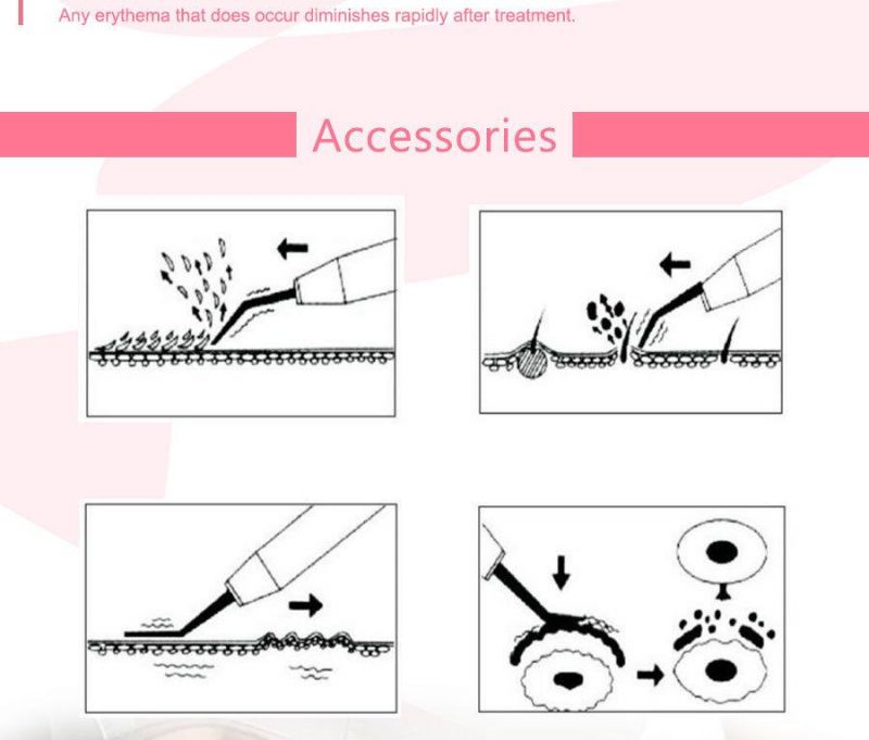 Handheld Supersonic Skin Scrubber for Skin Deep Cleaning