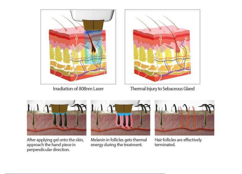 Triple Wavelength Diode Laser Hair Removal 755 808 1064 Laser/755 808 1064 3 Wave Diode Laser 755 808 1064