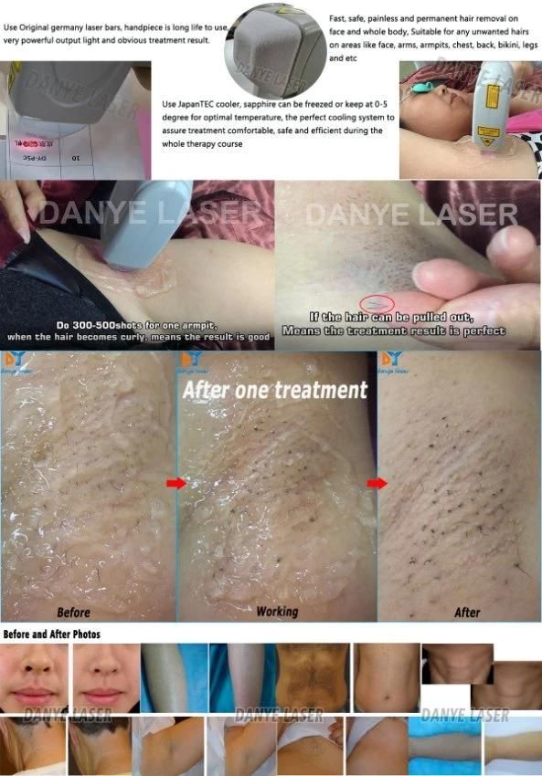 Trio Hair Removal Laser 808 755 1064 Three Wave Diode Depilation Laser