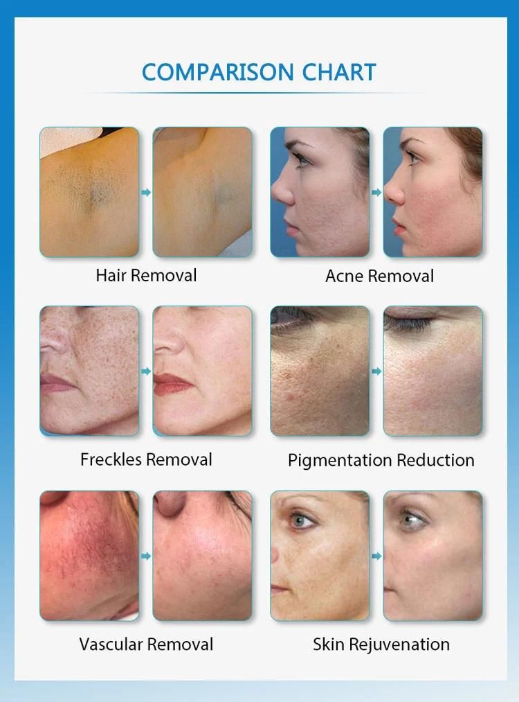 Best IPL Hair Removal Laser Beauty Equipment