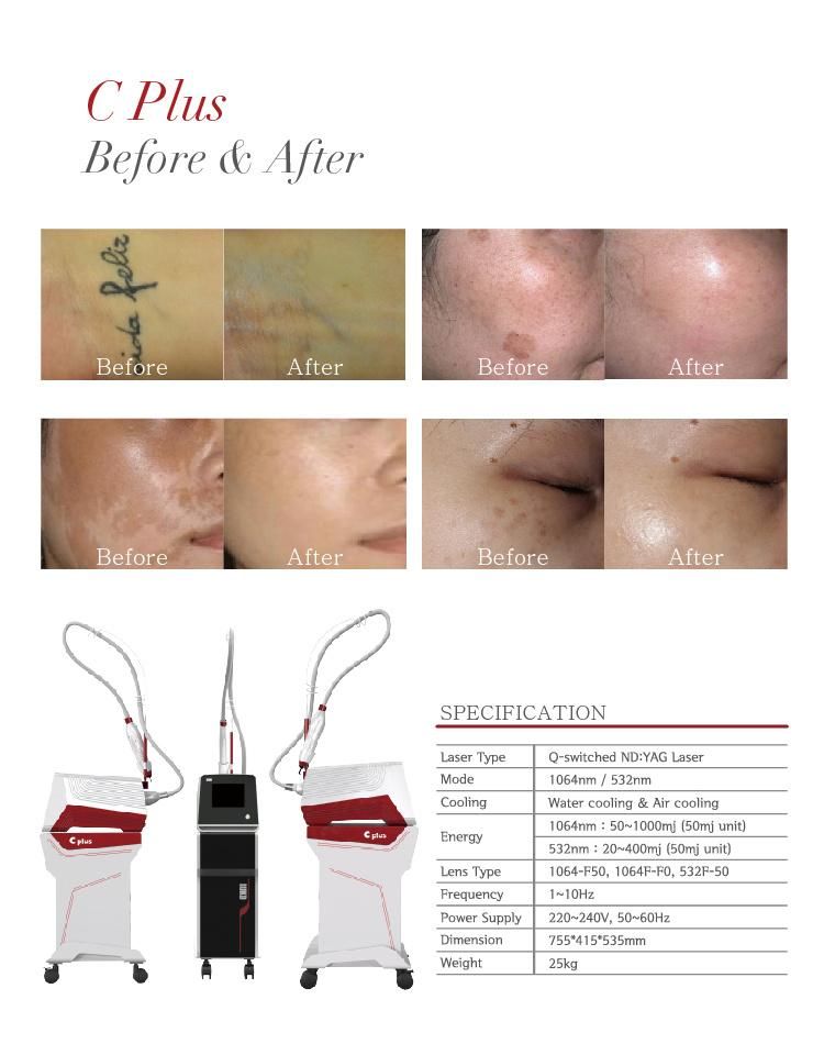 Sold out up to 2000 PCS Laser Tattoo Removal Machine