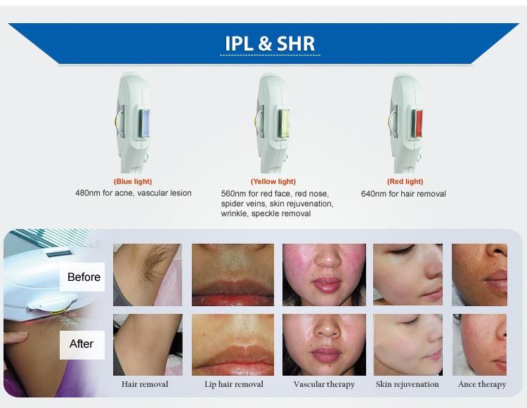 Portable IPL Machine for Sale IPL E-Light Hair Removal Equipment