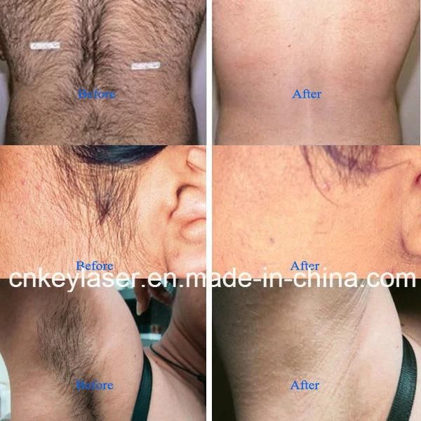 Wholesale Laser for Hair Removal Painfree 808nm Diode Laser
