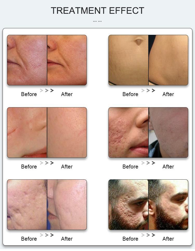 Acne Removal CO2 Fractional Laser RF Vaginal Tightening