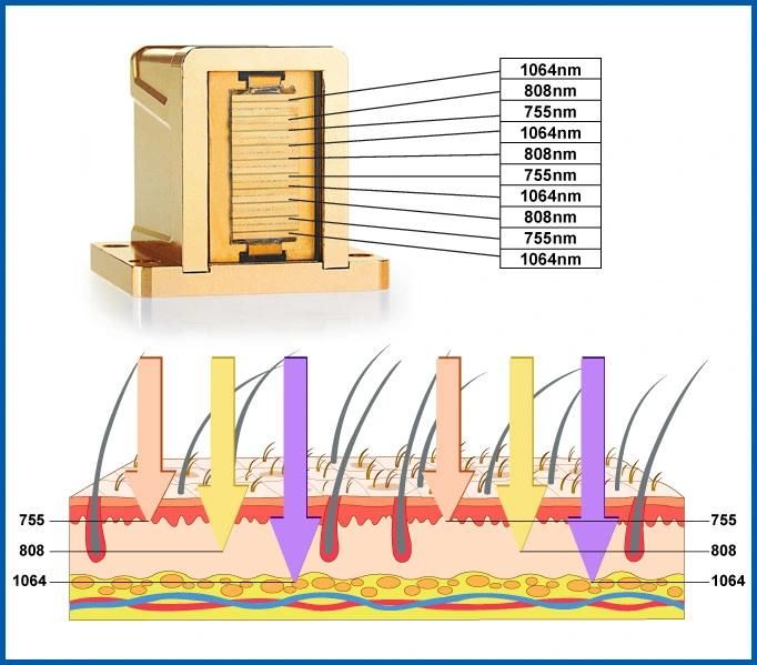 755 1064 808 Alma Soprano Laser Diode Hair Removal