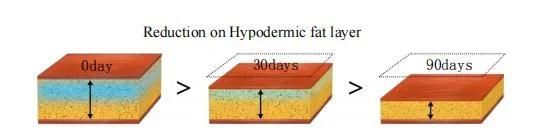 2022 Weight Loss Cryolipolyse Vacuum 360 Degree Surrounding Cryo Slimming Machine 360 Degree Surrounding Fat Cryo Freezing
