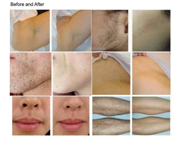 Professional Laser Hair Removal Machine 808nm Diode Laser Permanent Hair Removal