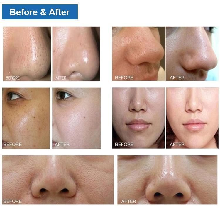 Hydra Dermabrasion Peeling Facial Skin Care Beauty Machine for Beauty Salon