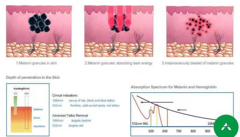 M-Q Switch YAG Laser Pigment Removal FDA Tattoos Removal