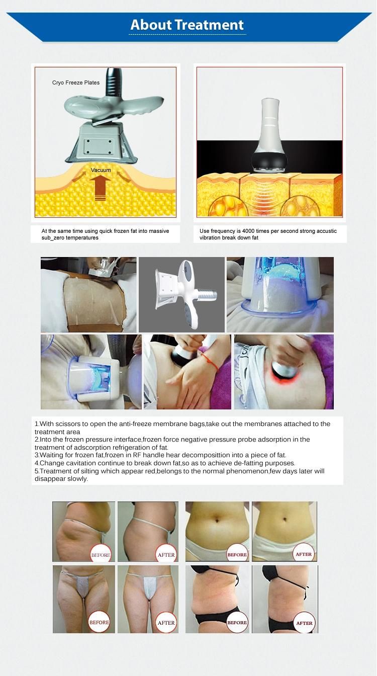 5 In1 Fat Freezing Machine Criolipolise with Double Chin and RF, Cavitation