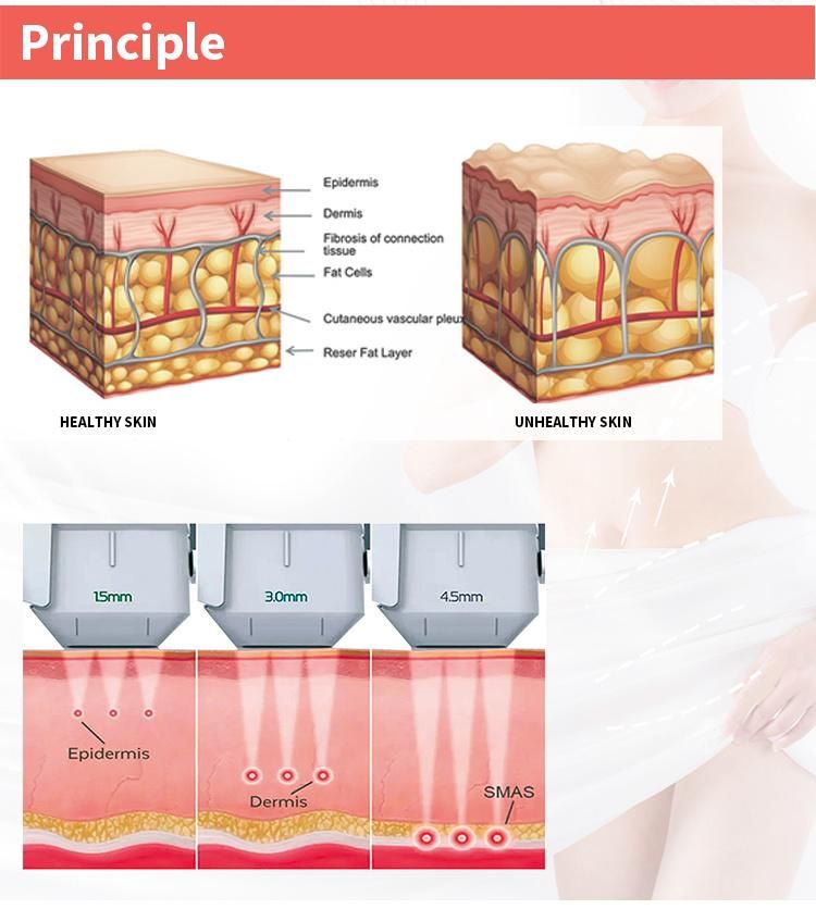 Hifu Focused Ultraspund Body Slimming Achine with Factory Price Skin Tightening Machine