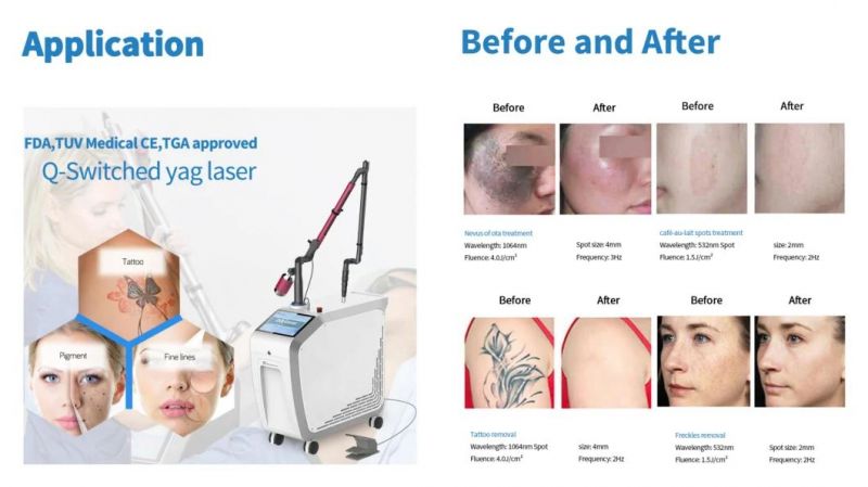 Consultant Be Tga Approved Exq Laser Q-Switched ND YAG with Pfc Modular and Power Supply From Japan Carbon Peeling