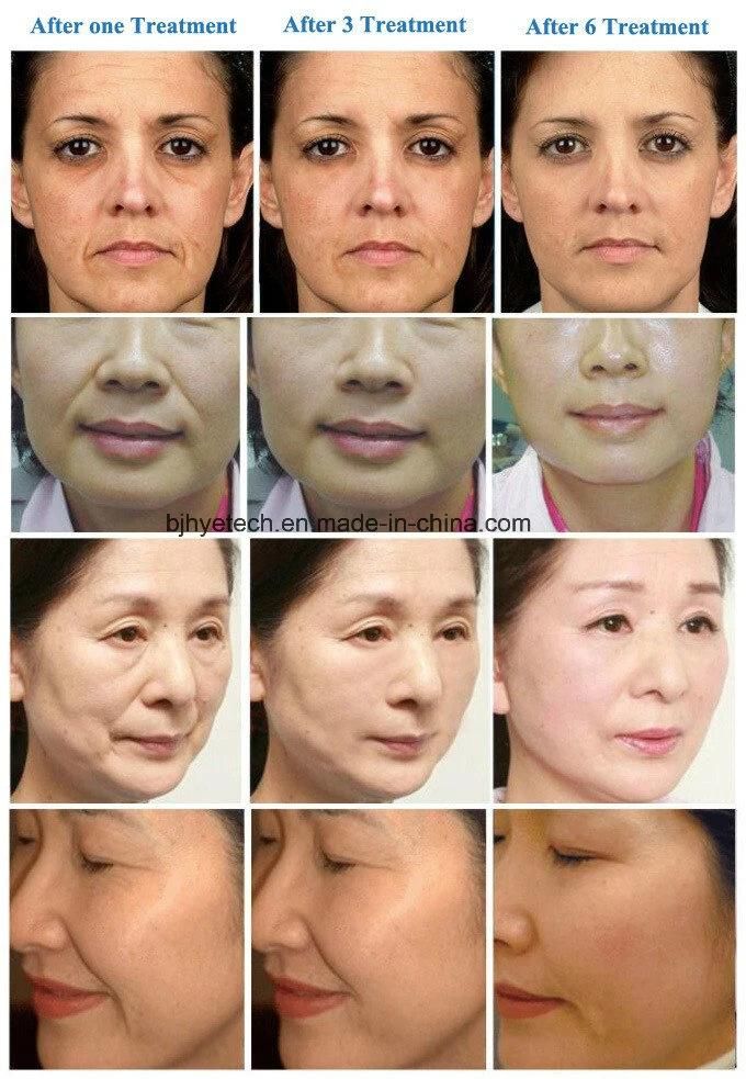 V-Max Ultrasound Radar Line Skin Rejuvenation Wrinkle Removal