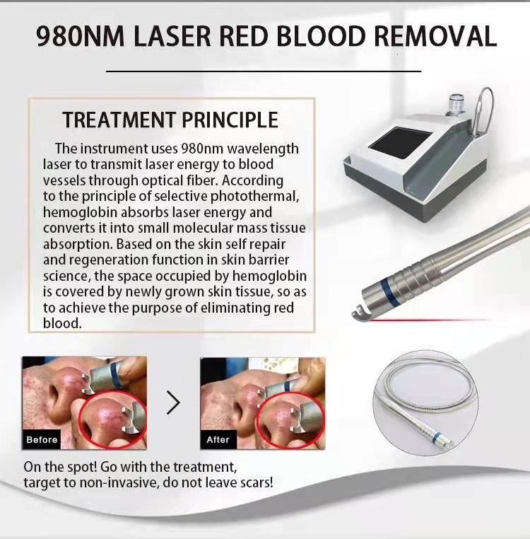 Portable 980nm Laser Spider Vein Removal Machine for Red Blood Removal