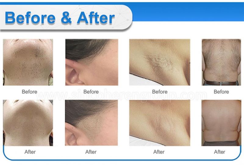 Jo. 808nm Diode Laser Painless Hair Removal Permanently Acne Remove Epidermal Pigmentation Remove Tua CE Approved Machine