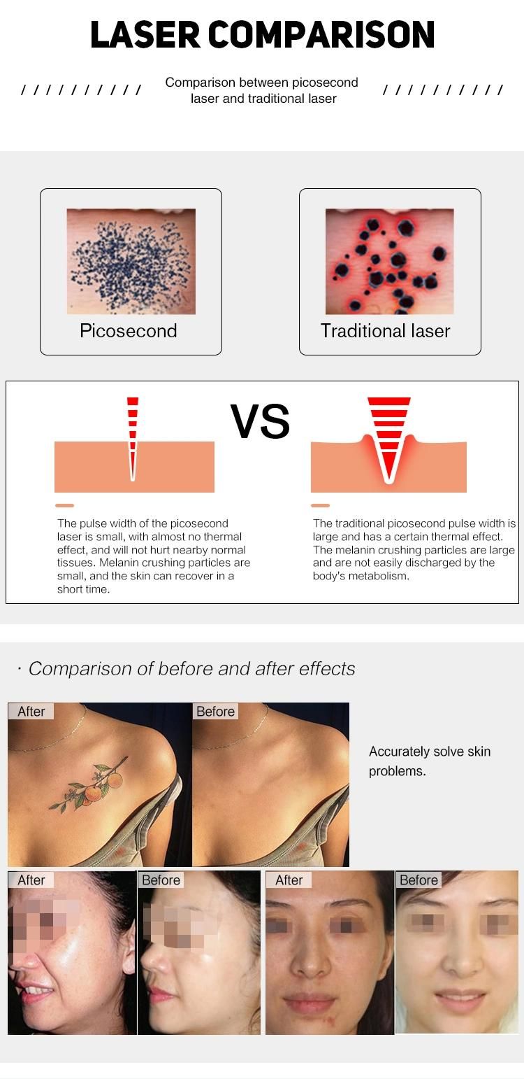 2021 New Arrival Picosecond Birth Mark /Pigment Black Spot Tattoo Removal Beauty Salon Equipment