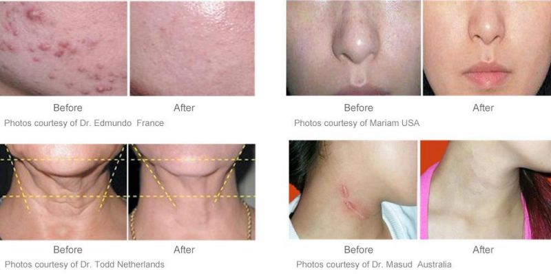 Medical Grande CE Approved Photodynamic Therapy PDT LED Light Machine for Acne Skin Rejuvenation