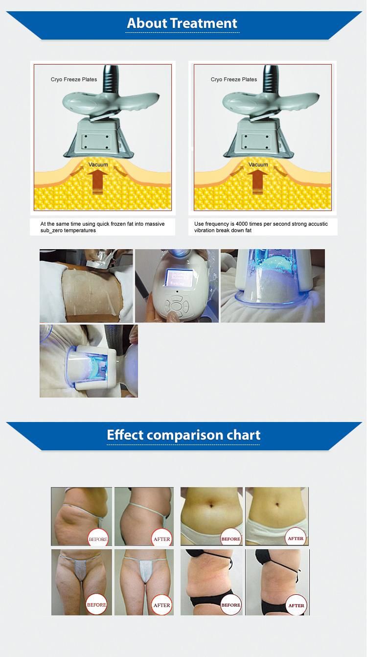 Both Cryo Handle Work at The Same Time Cavitation RF Slimming Machine