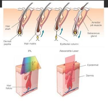 Long Pulsed ND YAG 1064nm Alexandrite 755nm Laser Gentle Max PRO Laser for Hair Removal Salon Laser