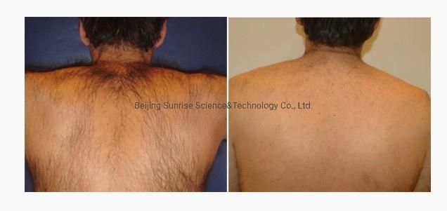 Multifunctional Beauty Equipment Depilation E-Light IPL RF ND YAG Laser Pigment Removal / ND YAG Laser Carbon Peeling