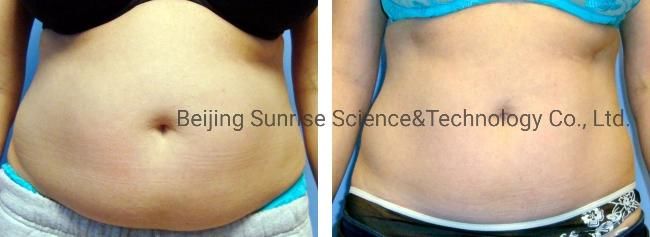 Sunrise 2022 Non Invasive Weight Loss Lipo Laser Machine 5D Lipo Laser Pay Later Option Lipo Laser Body Slimming Machine Price