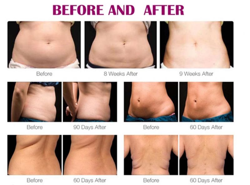 Lipo Laser Pads Liposuction Beauty Slimming Equipment for Weight Loss