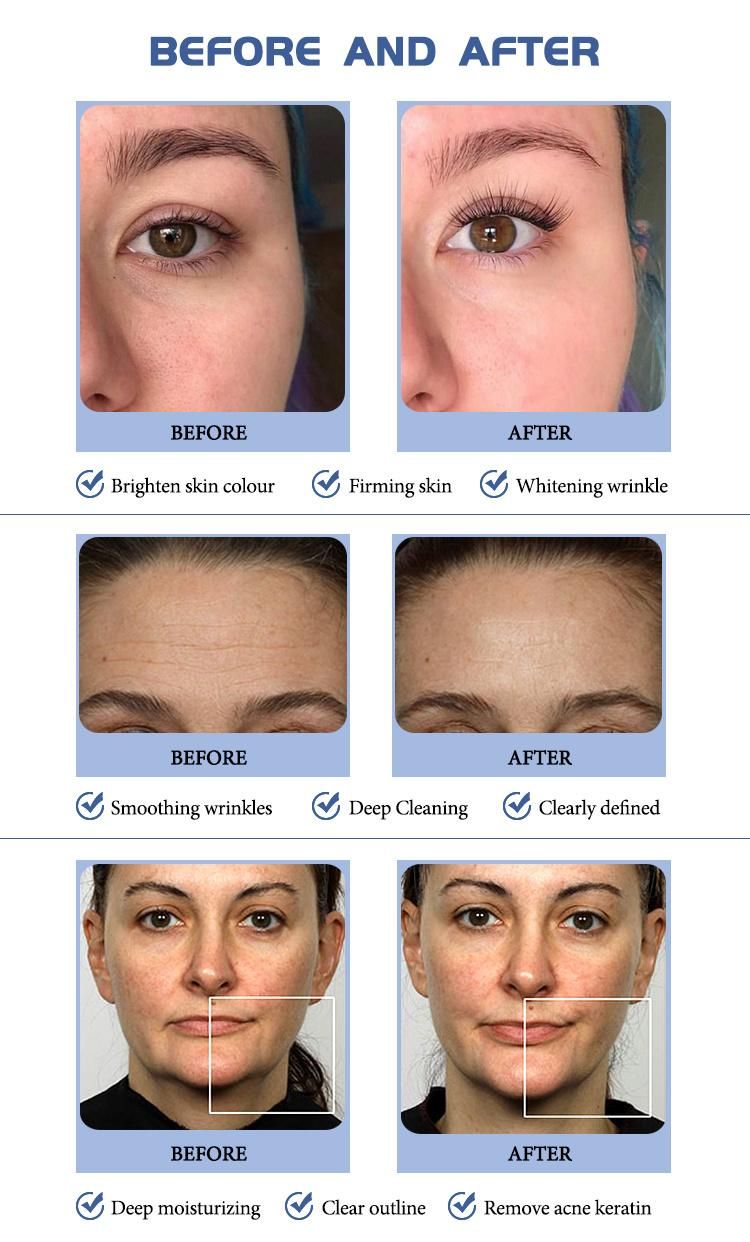 Hydra Aqua Jet Peel for Face Beauty with High Frequency Hydra Facial Equipment SPA909h