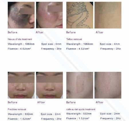 Pigment and Tattoo Removal Q-Switch ND YAG Laser